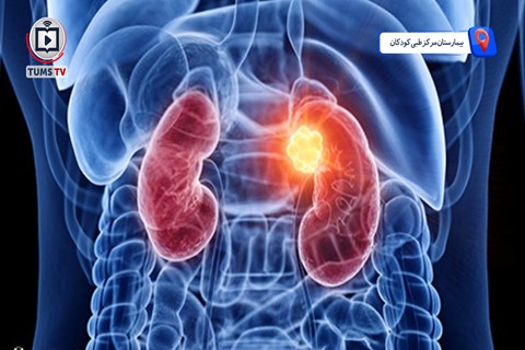 سرطان کلیه کودکان، نشانه‌های خاموش تومور ویلمز در کودکان